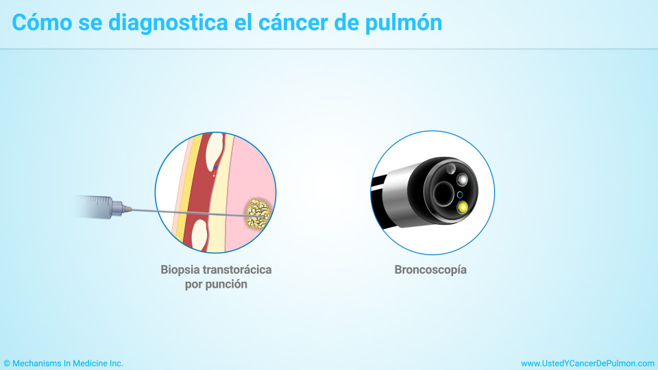 Cómo se diagnostica el cáncer de pulmón