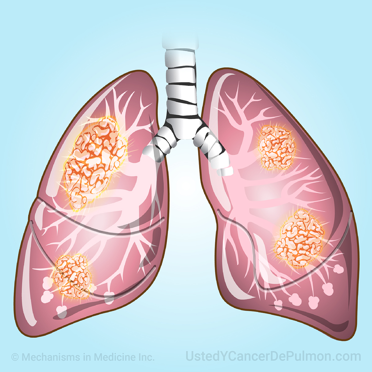 Aprenda acerca de una variedad de temas sobre el cáncer de pulmón a través de animaciones cortas