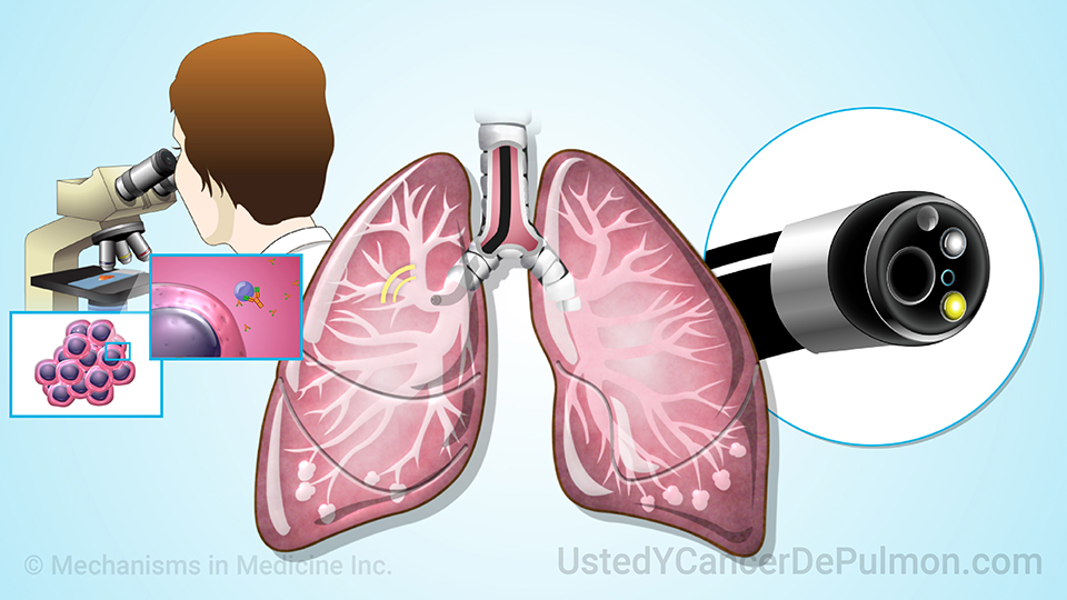 Animación - Diagnóstico y detección del cáncer de pulmón