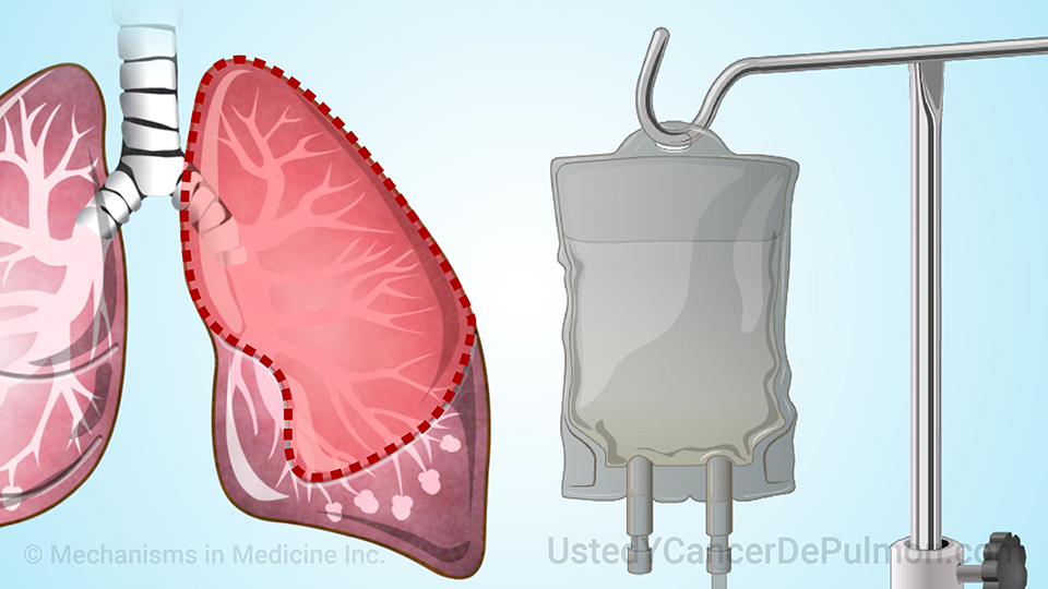 Tratamiento y manejo del cáncer de pulmón de células pequeñas