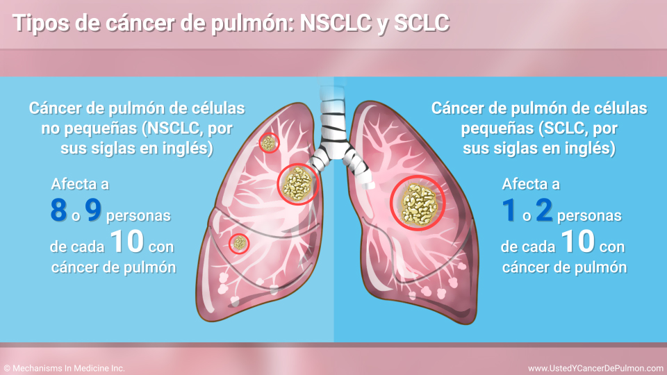Tipos de cáncer de pulmón: NSCLC y SCLC
