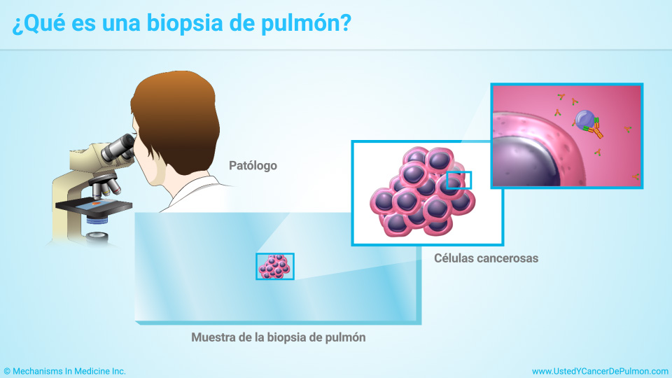 ¿Qué es una biopsia de pulmón?
