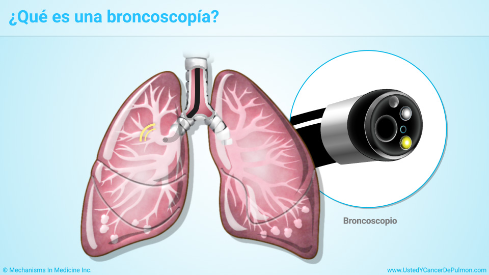 ¿Qué es una broncoscopía?