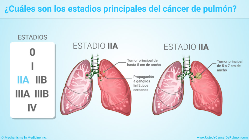 ¿Cuáles son los estadios principales del cáncer de pulmón?
