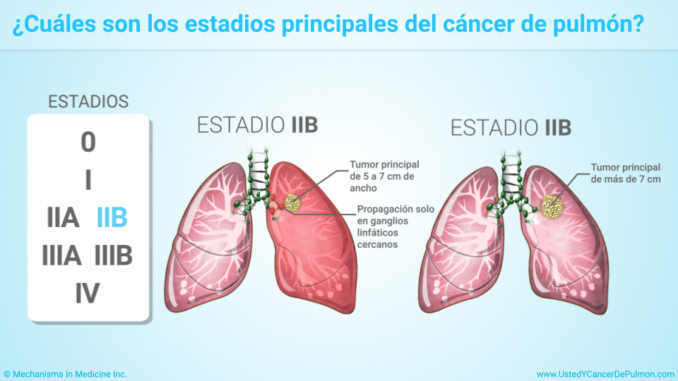 ¿Cuáles son los estadios principales del cáncer de pulmón?