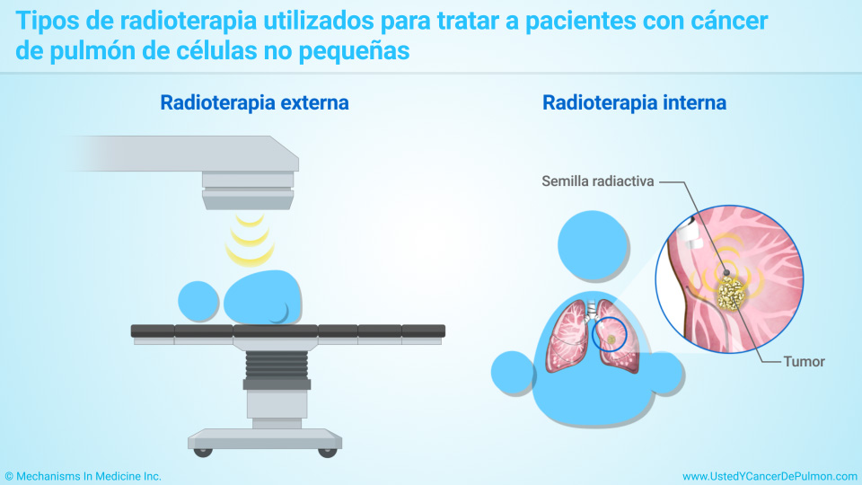 Tipos de radioterapia utilizados para tratar a pacientes con NSCLC