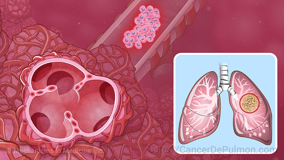Animación - Comprender el cáncer de pulmón de células no pequeñas