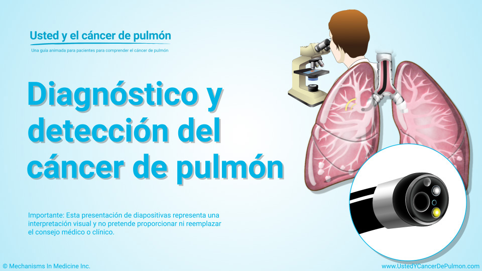 Presentación de diapositivas - Diagnóstico y detección del cáncer de pulmón