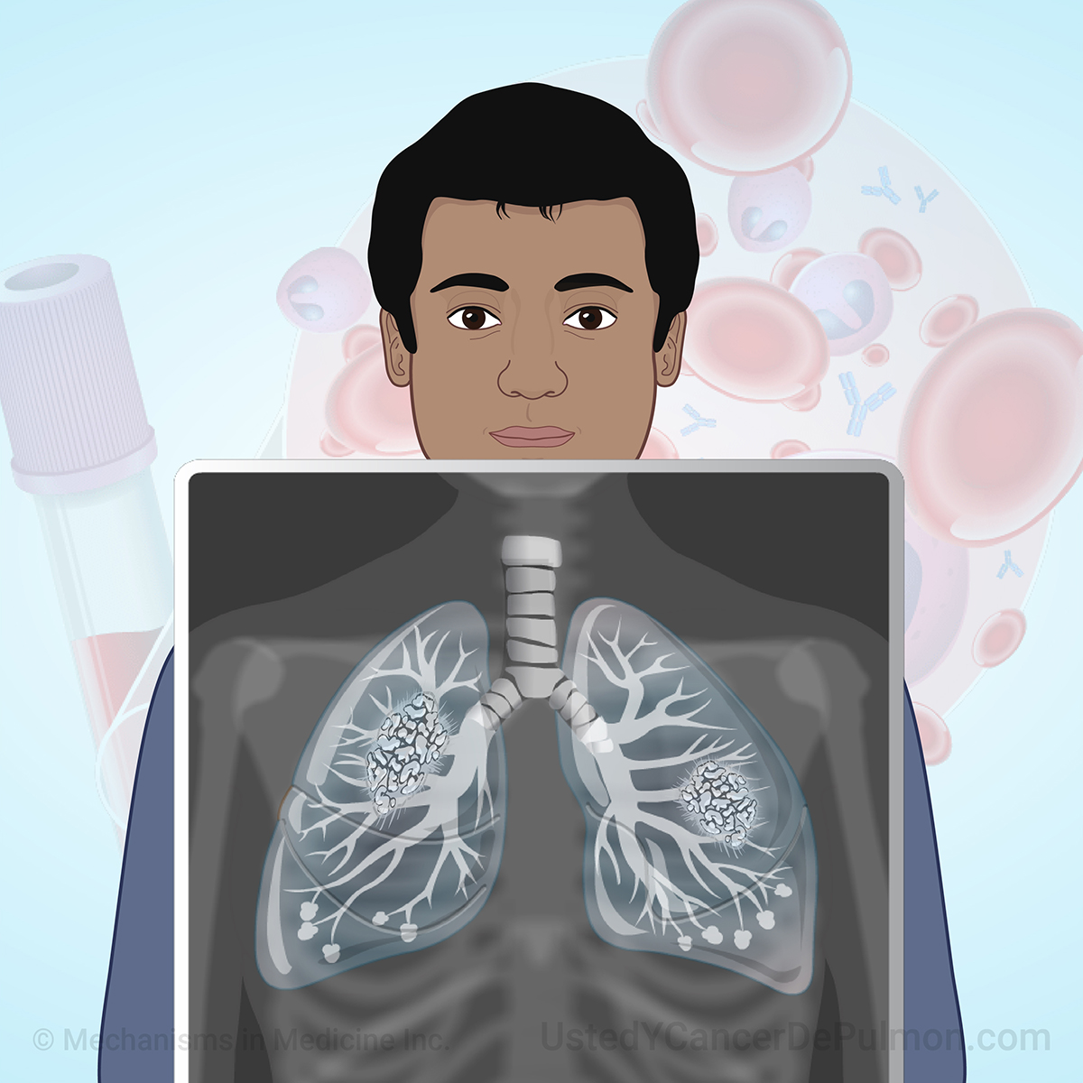 Diagnóstico y estadificación del cáncer de pulmón
