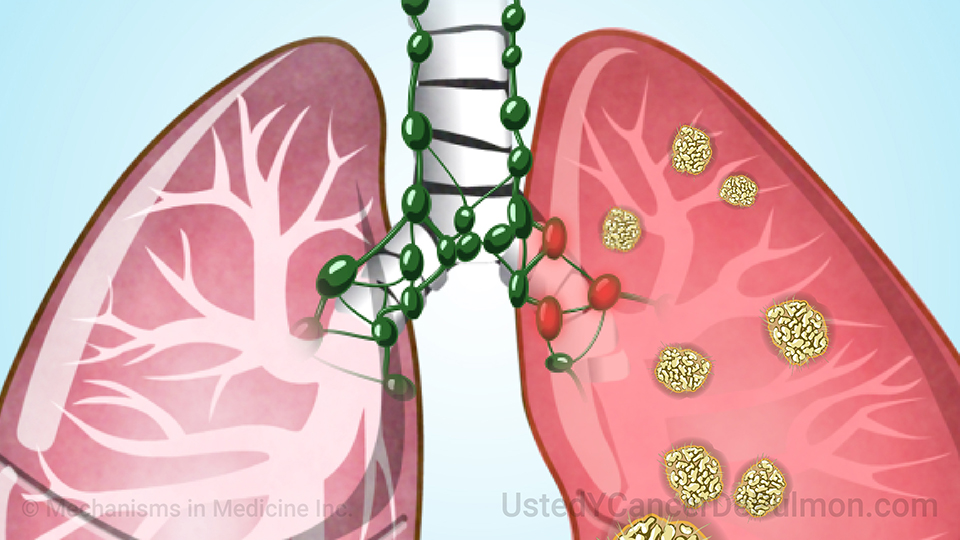 Animación - Estadificación del cáncer de pulmón